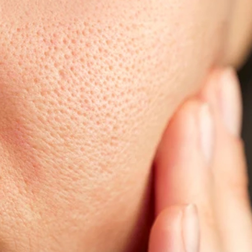 enlarged pores